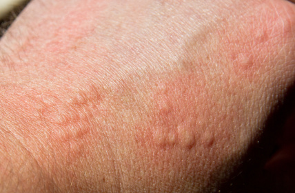 SCABIES VS BED BUGS – Bites, Symptoms and Treatments